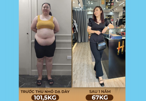 Giảm 35 kg một năm nhờ thu nhỏ dạ dày